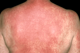 Cutaneous Drug Reactions